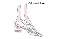 Risk Factors and Symptoms of Heel Spurs